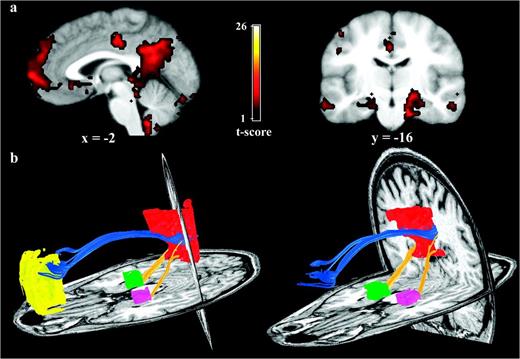 Functional connectivity reflects structural connectivity in the DMN. (a) Task-free, functional connectivity in the DMN is shown in a group of 6 subjects. The PCC/RSC and MPFC clusters are best appreciated on the sagittal view. Prominent bilateral MTL clusters are seen on the coronal image (left side of image corresponds to left side of brain). (b) DTI fiber tractography in a single subject demonstrates the cingulum bundle (blue tracts) connecting the PCC/RSC to the MPFC. The yellow tracts connect the bilateral MTL to the PCC/RSC. Note that generally the tracts from the MPFC enter the more rostral aspect of the PCC/RSC ROI corresponding to the PCC proper, whereas the tracts from MTL enter the more caudal aspect of the PCC/RSC ROI corresponding to the RSC proper. Left and right columns show slightly different views of the same tracts to highlight the distinct entry points into the PCC/RSC. There were no tracts connecting the MPFC to the MTL.