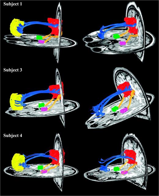 DTI fiber tractography in 3 additional subjects. In all cases, the MPFC fibers (blue tracts) enter the rostral (PCC proper) aspect of the PCC/RSC ROI, whereas the MTL fibers (yellow tracts) enter the more caudal aspect (RSC proper) of the PCC/RSC ROI. Left and right columns show slightly different views of the same tracts to highlight the distinct entry points into the PCC/RSC. There were no tracts connecting the MPFC to the MTL.