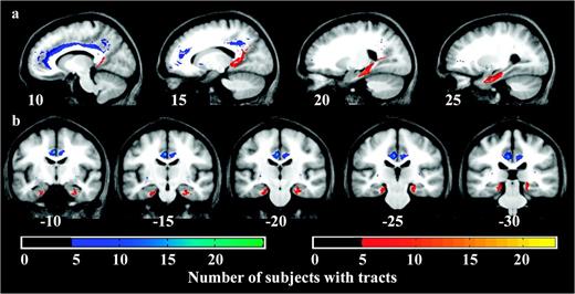 Tracts are consistent across subjects. (a) Sagittal views of the MPFC–PCC/RSC tracts (blue–green) and MTL–PCC/RSC tracts (red–yellow) where the color scales indicate the number of subjects that had a tract in a given voxel. The more medial sagittal views at x = 10 and x = 15 demonstrate the distinct entry points of the 2 tracts into the PCC/RSC with the MPFC fibers entering rostrally and the MTL fibers entering caudally. (b) Coronal views show the red–yellow MTL fibers coursing between the hippocampus and parahippocampal gyrus (whose anterior extent at y = −10 includes entorhinal cortex). There were no tracts connecting the MPFC to the MTL.