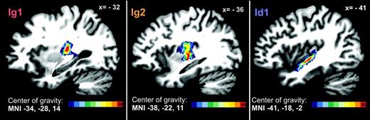 Interindividual variability of Ig1, Ig2, and Id1 in our sample of 10 brains visualized in the MNI single-subject template. The degree of overlap of the areas is color coded (see color bar). The stereotactic x-coordinates for the planes are given in the upper right corner. The centers of gravity (see Table 3) are given in the lower left corner.
