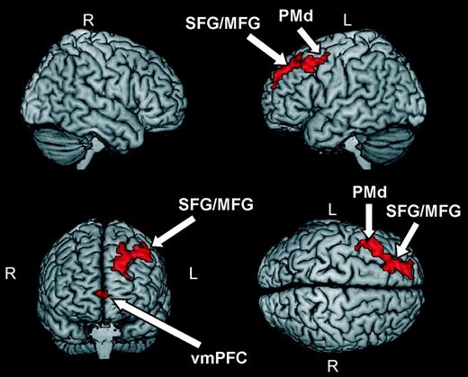 Brain areas showing higher BOLD responses during observation of human movements complying with normal kinematic laws of motion (see Table 1). Activations were thresholded at P < 0.001 (uncorrected) at the single-voxel level and at P < 0.05 (corrected) at the cluster level. Abbreviations: superior frontal gyrus (SFG), middle frontal gyrus (MFG), premotor dorsal (PMd), and ventromedial prefrontal cortex (vmPFC).