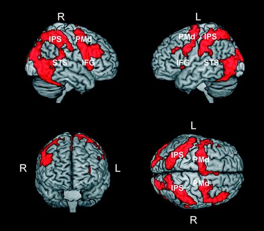 Brain areas activated by human movements independent of their compliance with normal kinematic laws of motion. The activation patterns in the figure were obtained by masking the contrast perturbed > baseline with the contrast normal > baseline. Prior to masking, activations in both contrasts were thresholded at P < 0.001 (uncorrected) at the voxel level and at P < 0.05 (corrected) at the cluster level. Abbreviations: PMd, premotor dorsal; IPS, intraparietal sulcus; STS, superior temporal sulcus; IFG, inferior frontal gyrus).