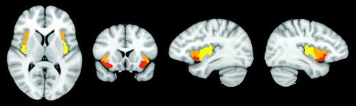 Three subregions of the right insula identified with cluster analysis. Ventral anterior insula (red), dorsal anterior to middle insula (orange), and posterior insula (yellow). Showing slices x = 36, x = −36, y = 14, z = 9. Images are in radiological convention.