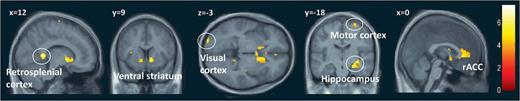 The global effect of music. Contrasting all music stimuli versus control stimuli highlighted significant activations in several limbic structures but also in motor and visual cortices. P ≤ 0.001, uncorrected.