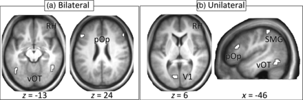 ROIs for (a) bilateral model and (b) unilateral model. RH = right hemisphere, vOT = ventral occipito-temporal cortex, pOp = pars opercularis, V1 = primary visual cortex, SMG = supramarginal gyrus.