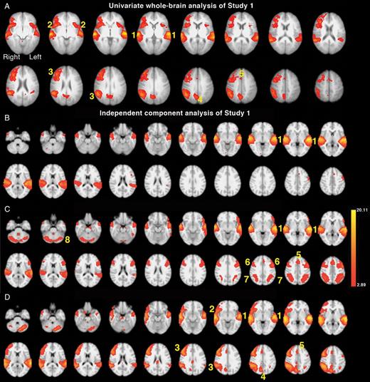 Axial slices are shown in radiological convention, that is the right hemisphere on the left of each slice, beginning with the most ventral slice. (A) Univariate whole-brain analysis of Study 1. The significant main effect of competing speech (MFDIOTIC/NON-PREDICTABLE + MFDIOTIC/PREDICATBLE) contrasted with noncompeting (MALONE/NON-PREDICTABLE + MALONE/PREDICTABLE) speech is projected as a red/yellow overlay, with a voxel-level threshold Z > 2.3, cluster-level threshold, P < 0.05. (1) Superior temporal gyri (STG); (2) anterior insula and frontal operculum (aI/FOp); (3) lateral prefrontal and inferior parietal cortical network (MFG/SMG); (4) precuneus; (5) dorsal anterior cingulate cortex and adjacent superior frontal gyrus (dACC/SFG). (B–D) Results from the 20-component independent-component analysis (ICA). (B). Component 2 demonstrated regions with significant activity during all listening conditions (including Tones) > Silence (P < 0.00001). (1) Bilateral STG. (C). Component 3 demonstrated areas of significant activity for all speech listening conditions > Silence (P < 0.00001). (1) Bilateral STG, (5) dACC/SFG, (6) Bilateral inferior frontal sulci (IFS), (7) bilateral intraparietal sulcus (IPS), (8) lateral cerebellar hemispheres. (D). Component 4 demonstrated a main effect of diotic speech (MFDIOTIC/NON-PREDICTABLE + MFDIOTIC/PREDICATBLE) > single speech (MALONE/NON-PREDICATBLE + MALONE/PREDICTABLE) (P < 0.00007). (1) Bilateral STG, (2) right aI/FOp, (3) MFG/SMG, (4) precuneus, (5) dACC/SFG.