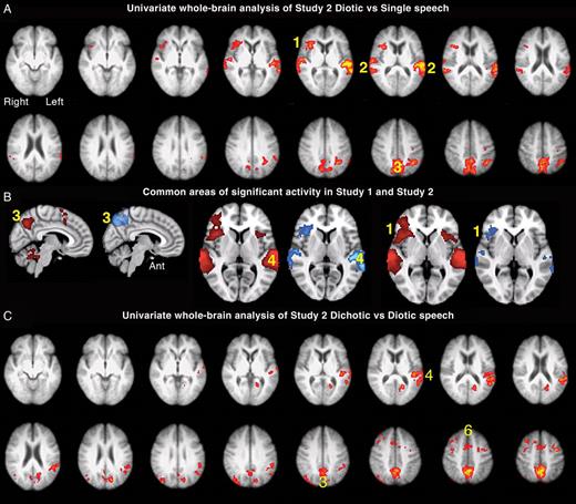 Axial slices displayed as in Figure 2. (A). Univariate whole-brain analysis of Study 2. There was a significant main effect of diotic (FBABBLE + FMDIOTIC) contrasted with single speech (FALONE) speech projected as a red/yellow overlay, with a voxel-level threshold Z > 2.3, cluster-level threshold P < 0.05. (1) Anterior insular/inferior frontal cortex (aI/IFG), (2) left planum temporale and adjacent anterior inferior parietal lobe (PT/IPL) and right posterior superior temporal gyrus (STG), (3) precuneus, (B) sagittal and axial views showing regions of common significant activity generated from the univariate analysis contrasting diotic speech to single speech, projected as red/yellow overlay in Study 1 and blue overlay in Study 2, with a voxel-level threshold Z > 2.3, cluster-level threshold P < 0.05. (1) Right aI/IFG, (3) (displayed on midline sagittal views) precuneus, (4) Left PT/IPL. (C). Demonstrates axial slices from the univariate contrast of Dichotic (MLEFTFRIGHT + FLEFTMRIGHT) > Diotic (FMDIOTIC). (3) Precuneus, (4) Left PT/IPL; (6) anterior cingulate cortex (ACC) and probably activity localized to frontal eye and supplementary eye fields.