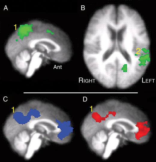 Univariate whole-brain analysis of Study 2, exploring 3 contrasts with a voxel-level threshold Z > 2.3 and cluster-level threshold, P < 0.05. (A) (sagittal midline projection) and (B) (axial section): dichotic (FLEFTMRIGHT + MLEFTFRIGHT) against diotic (FMDIOTIC + FBABBLE) projected as a green overlay. (1) precuneus, (2) left planum temporale and adjacent anterior inferior parietal lobe (PT/IPL). (C) (sagittal midline projection): rest against Diotic projected as a blue overlay. (1) Precuneus and adjacent posterior cingulate cortex (PCC). (D) (Sagittal midline projection): Rest against Dichotic projected as a red overlay. (1) Precuneus and PCC.