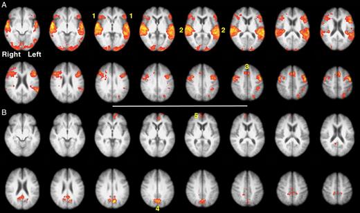 Two contrasts from Study 2: all trials with correct responses > all trials with incorrect responses (Panel A), and vice versa (Panel B), voxel-level threshold Z > 2.3, cluster-level threshold P < 0.05. (1) Anterior insula and adjacent frontal operculum (aI/Fop), (2) bilateral superior temporal gyri (STG), (3) dorsal anterior cingulate cortex and adjacent superior frontal gyrus (dACC/SFG), (4) precuneus and adjacent posterior cingulate cortex, (5) ventral medial prefrontal cortex.