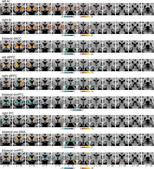 Seed-to-whole brain resting-state functional connectivity of known and potential noninvasive stimulation targets. Results of the seed-to-whole brain resting-state functional connectivity masked with a network computed from the subcortical ROIs: striatum (VS is outlined in white), amygdala, hippocampus and SN. Images displayed at P < 0.006 (FWE-corrected) and k > 0.