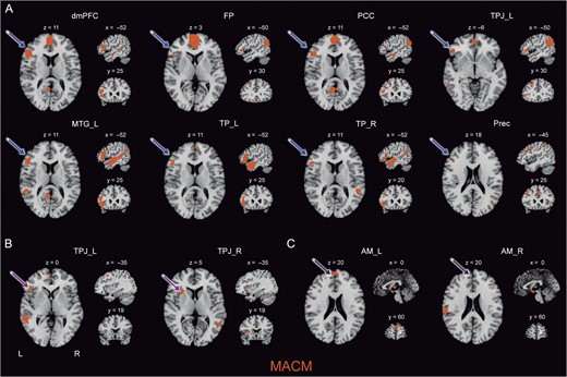 Lateralization effects in the social brain. Depicts most important hemispheric asymmetries in task-constrained brain states (MACM) in axial, sagittal, and coronal slices. (A) Most regions from the higher-level subnetwork showed a lateralized connectivity pattern with the IFG constrained to the left hemisphere. (B) The left TPJ seed yielded lateralized coactivation with semantic processing regions such as the IFG in the left hemisphere, whereas the right TPJ seed coactivated with attention-related structures such as the AI. (C) The AM seed in the left hemisphere showed specific connectivity with the dmPFC, in contrast to the AM seed in the right hemisphere. All results are cluster-level corrected for multiple comparisons. For abbreviations see Table 1.