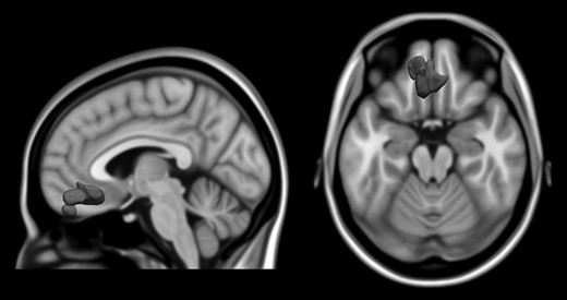 Results from whole brain voxel-wise analyses regressing baseline regional gray matter volume against SDQ HYPERACTIVE/INATTEntive score (assessed approximately 5 years later at follow-up). Age, sex, handedness, total gray matter volume (GMV), site, pubertal development, performance IQ, verbal IQ, and socioeconomic status were controlled for in the analysis. An initial height threshold of P ≤ 0.001 was implemented at the voxel level, with a corrected family-wise error (FWE; P ≤ 0.05) subsequently applied to identify significant clusters (N = 1104). In axial view, left is left.