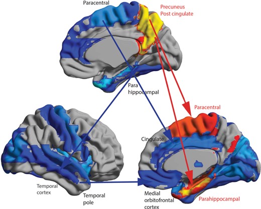 Summary of some of the main differences in effective connectivity in schizophrenia. The source regions (Region 1) are shown in the upper view of the brain, and the target regions (Region 2) in the two lower views of the brain. The AAL2 areas with these differences show higher effective connectivity in red to yellow; and lower effective connectivity in blue. The two main higher effective connectivities are shown here. Further lower effective connectivities were found than can be indicated in arrows, with the further details shown in Tables 1 and 4.