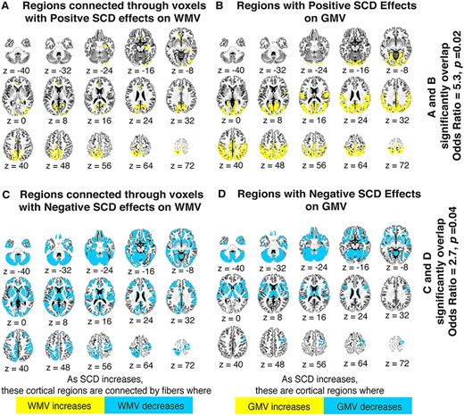 Coordination of regional WMV and GMV changes with SCD variation. (A) Yellow gray matter regions are those connected by white matter tracts that have at least 50% of their voxels scaling positively with increased X-and Y-chromosome dosage. (B) Yellow gray matter regions are those showing significant volumetric increases with increased X- and Y-chromosome dosage. (C) Blue gray matter regions are those connected by white matter tracts with at least 50% of their voxels scaling negatively with increased X- and Y-chromosome dosage. (D) Blue gray matter regions are those showing significant volumetric decreases with increased X- and Y-chromosome dosage. Fisher’s exact tests demonstrated a significant overlap between maps A and B (odds ratio = 5.3, P = 0.02), as well as between maps C and D (odds ratio = 2.7, P = 0.04), suggesting a strong congruence between SCD effects on white and gray matter in the human brain. Maps are presented in Desikan-Killiany space, and were generated with the help of IIT Atlas resources (see methods for details).