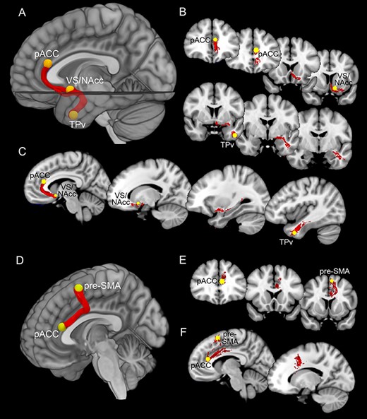 Upper part: white matter tracts connecting pACC, VS/NAcc, and TPv. Lower part: white matter tracts connecting pACC and pre-SMA. Panels (A) and (D) showed the averaged white matter tracts connecting the pACC, VS/NAcc, and TPv and those connecting pACC and pre-SMA in a mesial view of 3D reconstructions. Panels (B) and (E) showed white matter tracts connecting the pACC, VS/NAcc, and TPv and those connecting pACC and pre-SMA in a series of coronal sections ordered from rostral to caudal. Panels (C) and (F) showed white matter tracts connecting the pACC, VS/NAcc, and TPv and those connecting pACC and pre-SMA in a series of parasagittal sections ordered from mesial to lateral.