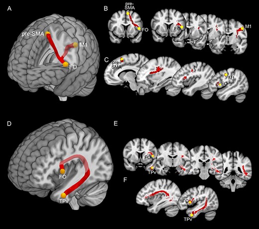 Upper part: white matter tracts connecting pre-SMA, FO, and M1. Lower part: white matter tracts connecting FO and TPv. Panels (A) and (D) showed the averaged white matter tracts connecting the pre-SMA, FO, and M1 and those connecting FO and TPv in a mesial view of 3D reconstructions. Panels (B) and (E) showed white matter tracts connecting pre-SMA, FO, and M1 and those connecting FO and TPv in a series of coronal sections ordered from rostral to caudal. Panels (C) and (F) showed white matter tracts connecting pre-SMA, FO, and M1 and those connecting FO and TPv in a series of parasagittal sections ordered from mesial to lateral.