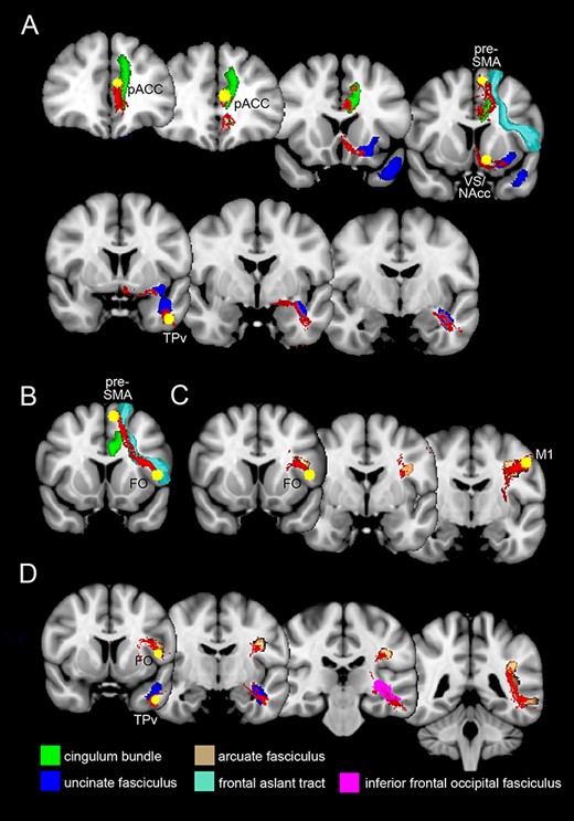 Overlapping of white matter tracts of the present study (in red) with those available from the atlas of the BCBToolkit software (Foulon et al. 2018), showed in a series of coronal sections. (A) Overlapping of the white matter tracts connecting pACC, VS/NAcc, TPv, and pre-SMA with the anterior cingulate bundle, the uncinate fasciculus, and the frontal aslant tract. (B) Overlapping of the white matter tract connecting the pre-SMA and FO with the frontal aslant tract. (C) Overlapping of the white matter tracts connecting FO and M1 with the arcuate fasciculus. (D) Overlapping between the white matter tracts connecting FO and TPv with the arcuate, inferior frontal occipital, and the uncinate fasciculus.