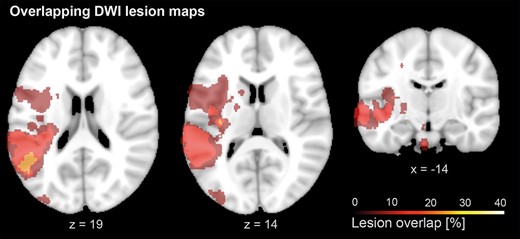Lesion overlap: Lesion overlap of stroke patients, based on diffusion MRI. Lesion maps showed maximal overlap in the posterior insula and the superior temporal gyrus, extending into the inferior parietal lobule. A list of individual lesion locations is provided in the Supplementary Table S2).