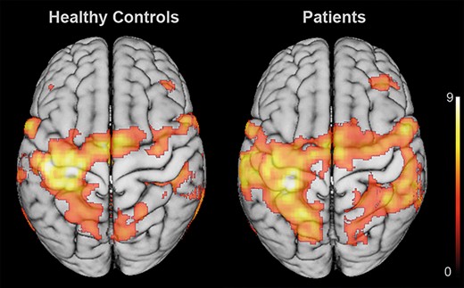 Group effects of BOLD activation: BOLD activation across healthy controls (left) and patients (right), indicating a more bilateral activation pattern after stroke. Notably, patients featured a widespread recruitment of ipsilesional sensorimotor cortex and contralesional frontoparietal regions. Statistical maps were rendered on a 152 T1 average brain template. Results were FWE cluster-level corrected at a threshold of P < 0.05 (cluster-forming threshold at the voxel level: P < 0.001).
