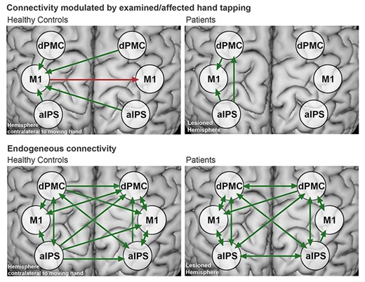 Effective connectivity in healthy controls and patients:Top row: Significant effective connectivity modulated by finger-tapping in healthy participants (DCM-B) (left) and patients (right). The green arrows indicate positive, and the red arrows indicate negative coupling. Bottom row: Endogenous connectivity in healthy controls and patients (DCM-A). Connectivity did not significantly differ between groups. All results were FDR-corrected for P < 0.05. A list of mean connectivity strengths and statistics is provided in the Supplementary Table S3).
