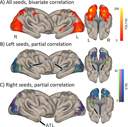 Resting-state connectivity of the 6 ROIs. (A) Brain regions connected to at least one of the 6 color seeds, as computed with an F test. (B–C) Unique connectivity patterns as assessed with partial correlations, for the left- (B) and right-hemispheric (C) seeds. Voxelwise P < 0.001, clusterwise P < 0.05 FDR corrected. Arrows indicate STG, PHC, and the ATL.