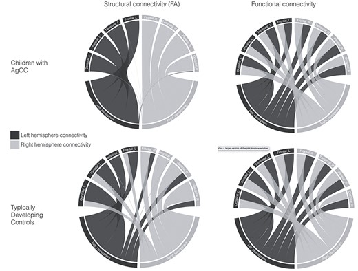 Summary of structural connectivity (fractional anisotropy, FA) and functional connectivity in children with AgCC and TDC. Gray lines represent connectivity in the right hemisphere, and blue lines represent connectivity in the left hemisphere. There is a shift from interhemispheric to intrahemispheric structural connectivity in children with AgCC compared to the TDC group, while the pattern of functional connectivity is similar between the two groups.