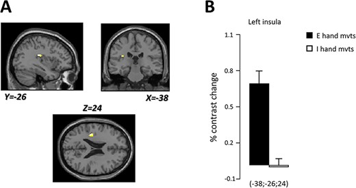 (A) Localization of the cluster found in the left insular cortex (white spot) specifically engaged during executed compared to imagined hand movements. Brain responses are projected onto the sagittal (Y = −26), coronal (X = −38), and axial (Z = 24) views of the T1-single subject template of MNI. (B) Percent contrast change in the left insular cortex during executed (black) and imagined (white) vertical hand movements.
