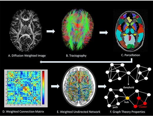 Network analysis methodological protocol. (A) Represents a diffusion MR image. (B) Tractography is carried out through ExploreDTI to delineate WM tracts; Genu of corpus callosum is shown. (C) Cortical and subcortical structure parcellation by AAL. (D) Weighted connectivity matrix. (E). Weighted undirected network. (F) Metrics used in BCT to characterize brain topology shows a network above and after thresholding only identifies stronger connections. (F) Describes a path indicated by the dashed line, a hub that highlights many interconnecting links is identified in yellow, and a cluster of nearest neighboring nodes is highlighted in red.