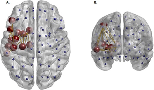 Red nodes reflect a subnetwork of brain regions with a significantly lower density (NOS-weighted) in the BD group compared with the HC group identified at T > 2. Blue nodes reflect the additional nonsignificant nodes defined by the AAL atlas. This left hemispheric component comprised of the frontal inferior operculum, frontal inferior triangularis, rolandic operculum, insula, caudate, putamen, thalamus, hippocampus, Heschl’s gyrus, middle and superior temporal gyri, and pre and post central gyri.