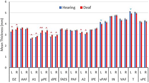 Mean cortical thickness values for each auditory region. Regions sorted based on dorsoventral position in the brain, with more dorsal regions being on the left. Blue downward pointing arrows () indicate significant decreased thicknesses in the deaf group and red upward pointing arrows () indicate increased thickness. Data presented as mean + SEM. ^P < 0.05, ^^P < 0.01 between the hearing and deaf conditions.