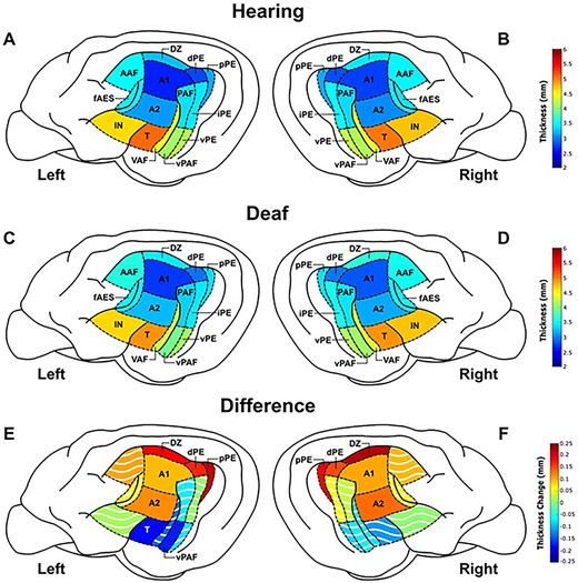 Visual representation of mean thicknesses and thickness differences between the two groups. ROIs in the hearing left a) and right b) hemispheres and deaf left c) and right d) hemispheres are shown with mean thicknesses in mm. Thickness differences between the two groups in the left e) and right f) hemispheres shown as deaf mean minus hearing mean for each ROI in mm, with solid colors denoting significant changes (Table 1). The dorsal zone (DZ), dorsal and posterior divisions of posterior ectosylvian auditory cortex (dPE, pPE), primary auditory cortex (A1), and secondary auditory cortex (A2) were all significantly thicker in the deaf group bilaterally. Temporal auditory cortex (T) and the VPAF were found to be significantly thinner in the left hemisphere only.