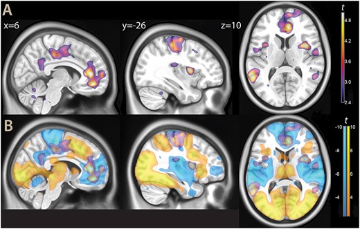 A) Parametric maps, contrast high vs low evidence decision (thresholded at P < 0.01 for illustration purposes), overlaid on a template brain. B) The same contrast, displayed together with task activations (yellow) and deactivations (light blue, same threshold).