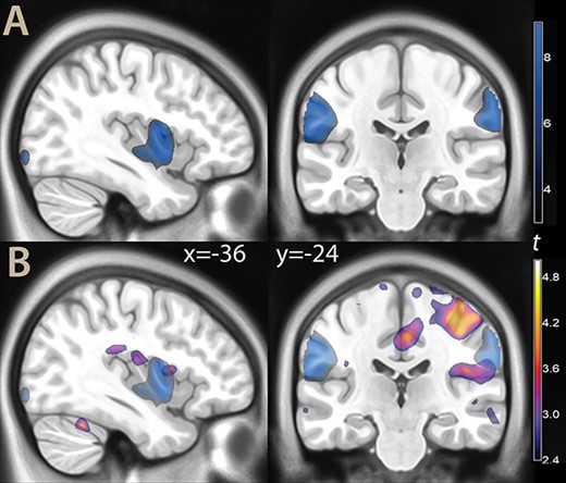 A) Parametric t map of the contrast painful images vs neutral (illustration threshold P < 0.01), overlaid on a template brain. B) The same contrast (blue color), displayed together with the effect of evidence for decisions (as in Fig. 2).
