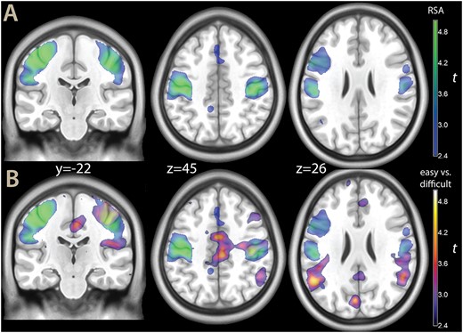A) Parametric map of the RSA for pain (in blue-green), and B) The same map, shown with the contrast high vs low evidence decision (the same as shown in Fig. 2, in blue-yellow), overlaid on a template brain. Both contrasts were thresholded at P < 0.001 for illustration purposes.