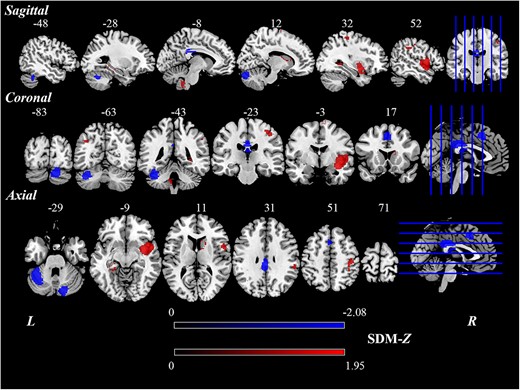 Brain regions showing significant differences of regional spontaneous brain activity between poststroke aphasia patients and HCs based on the meta-analysis.
