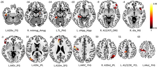 Increased activations of PBD1 patients than HCs in contrast of emotional distractor versus neutral distractor during Go Nogo task (FDR-corrected). Active clusters were found covering frontal lobe, parietal lobe, temporal lobe, limbic lobe, insula, and subcortical nucleus. The brain atlas that partitions the cerebral cortex into 246 ROIs was used to identify the activated brain regions. After overlapping the group activation map and the atlas, 13 brain regions were survived including A10m (SFG), A45r (IFG), A12/47 l (FOG), A4hf (PrG), A4ul (PrG), A1/2/3ll (PCL), A20iv (ITG), TL (PhG), A39c (IPL),A39rd (IPL), dIa (insula), mAmyg (amygdala), and cHipp (hippocampus). The fMRI signals the brain regions were extracted for further HE calculation.