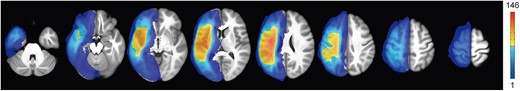 Lesion overlap map for 216 included patients in this study. The map showed regions with no overlap to maximum overlap (n = 146 participants).