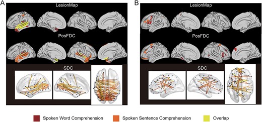 Overlap of significantly contributing regions between spoken word and sentence comprehension. (A) Overlap of negative correlations. (B) Overlap of positive correlations. The deep red color represents a significant correlation solely with spoken word comprehension, orange indicates a significant correlation solely with spoken sentence comprehension, and yellow indicates a significant correlation with both behavioral measures.