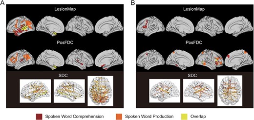 Overlap of significantly contributing regions between spoken word comprehension and production. (A) Overlapping negatively associated regions and edges. (B) Overlapping positively associated regions and edges. The deep red color represents a significant correlation solely with spoken word comprehension, orange suggests a significant correlation solely with spoken word production, and yellow indicates a significant correlation with both behavioral measures.