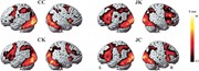 Brain activation is associated with the rhyming judgment task of Chinese ch...