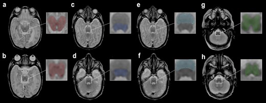 Female neonate with IVH grade III, born at 24 + 0 wk GA. MRI performed 93 days postpartum. ROIs were drawn on an MDME-based T2 contrast on a transversal plane. ROIs of the midbrain at the level of the a) superior colliculi b) inferior colliculi. c) Pontine tegmentum and e) basis pontis at the level of the superior olive. d) Pontine tegmentum and f) basis pontis at the level of the vestibular nuclei. Medulla oblongata at the level of the g) medial lemniscus (decussation) and h) inferior olivary nucleus.