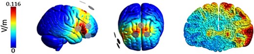 Electrical current flow modeling for the tACS (2 × 1) electrode montage over the rIFG and preSMA (adapted from the importance of model-driven approaches to set stimulation intensity for multi-channel tACS, by Tan et al., published in Brain Stimulation, 2019, under a CC BY 4.0 license. Vol75 (mesh volume with field strength ≥75% of the 99.9th percentile) and Vol50 (mesh volume with field strength ≥50% of the 99.9th percentile) provide measures of focality. The gray circles represent the rubber electrodes (2 cm diameter) with 2 active electrodes placed anteriorly and one return electrode placed posterior to the target region. The current amplitude (1 mA peak-to-peak) was equally split between the 2 active electrodes.