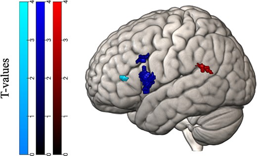 Significant clusters of voxels during the grammaticality task (finiteness > grammatically correct contrast) in the phonological and semantic functional localizers. Significant clusters in the phonological regions are located in the pSTG, depicted on the right, and opIFG in the middle. Significant clusters in the semantic regions are in the trIFG, depicted on the left.
