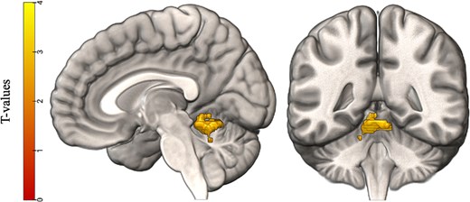 Results of the exploratory whole-brain analyses. Visualized is a significant cluster in the grammaticality task (finiteness > grammatical) that showed a negative correlation with general language abilities as measured by the sentence repetition subtest on the CELF-5. Using the SUIT atlas, clusters were determined to be in the left and right anterior lobe of the cerebellum (lobule I to IV, see Table 6).