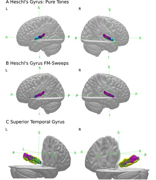(A and B) 3D view of voxels showing significant ($P < 0.05$, FDR-corrected) SSA (purple) within Te1.0 (dark blue), Te1.1 (green), and Te1.2 (light blue). (C) Voxels of Te3 (yellow) showing significant ($P < 0.05$, FDR-corrected) SSA to both, pure tones and FM-sweeps (purple), voxels showing SSA only to pure tones (blue) or FM-sweeps (green).