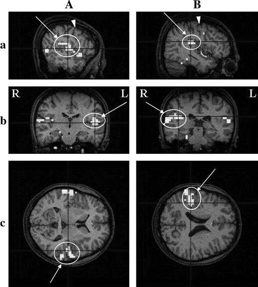 Activation detected in the Pop comprising area G in an individual cerebral cortex, revealed by fMRI. Activated regions on the left (A) and right (B) hemispheres are shown in three dimensions; coronal (a), sagittal (b), and horizontal (c) sections. The HRF was delayed by 5 volumes after the onset of the stimulation period. Circles with arrows indicate activated regions. Arrowheads show the cs. R, right side; L, left side. Threshold, P < 0.001; multiple comparisons over the entire volume (FDR). Subject YF2. A pseudocolor bar indicates the Z score scale.