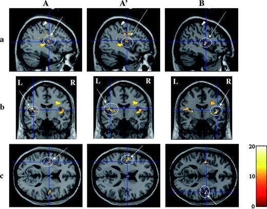 Three-dimensional images of activation in area G revealed by group analysis with a random-effect model within the ROI. (A and A′) Activations on the left side of the cerebral hemisphere. (B) Activations on the right side. (A and B) Activations with foci between the buried Pop and superior posterior insula; A′, buried Pop. ROI analysis was applied to the cubic with a centroid at (±47, −18, 15) and an edge length of 20 mm. Activations at both Pop and superior posterior insula on the left side were found at the same cluster. Threshold, P < 0.02; multiple comparison (FWE) corrected. See the legend of Figure 4 for other details of signs and marks.