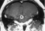 Enhancing microabscess in the brain stem of a 72-year-old man who presented with ataxia, cranial nerve palsies, and fever. Blood culture yielded Listeria monocytogenes.