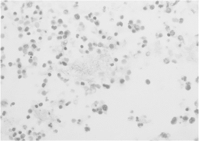 gram stain preparation of a lung tissue specimen showing aggregates of gram negative bacilli