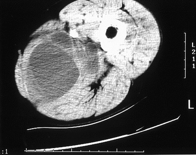 CT of thigh demonstrating loculated fluid in posteromedial muscle compartment.